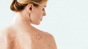 Individuare il melanoma (depositphotos) - zapster.it