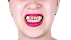 Denti mancanti (depositphotos) - zapster.it