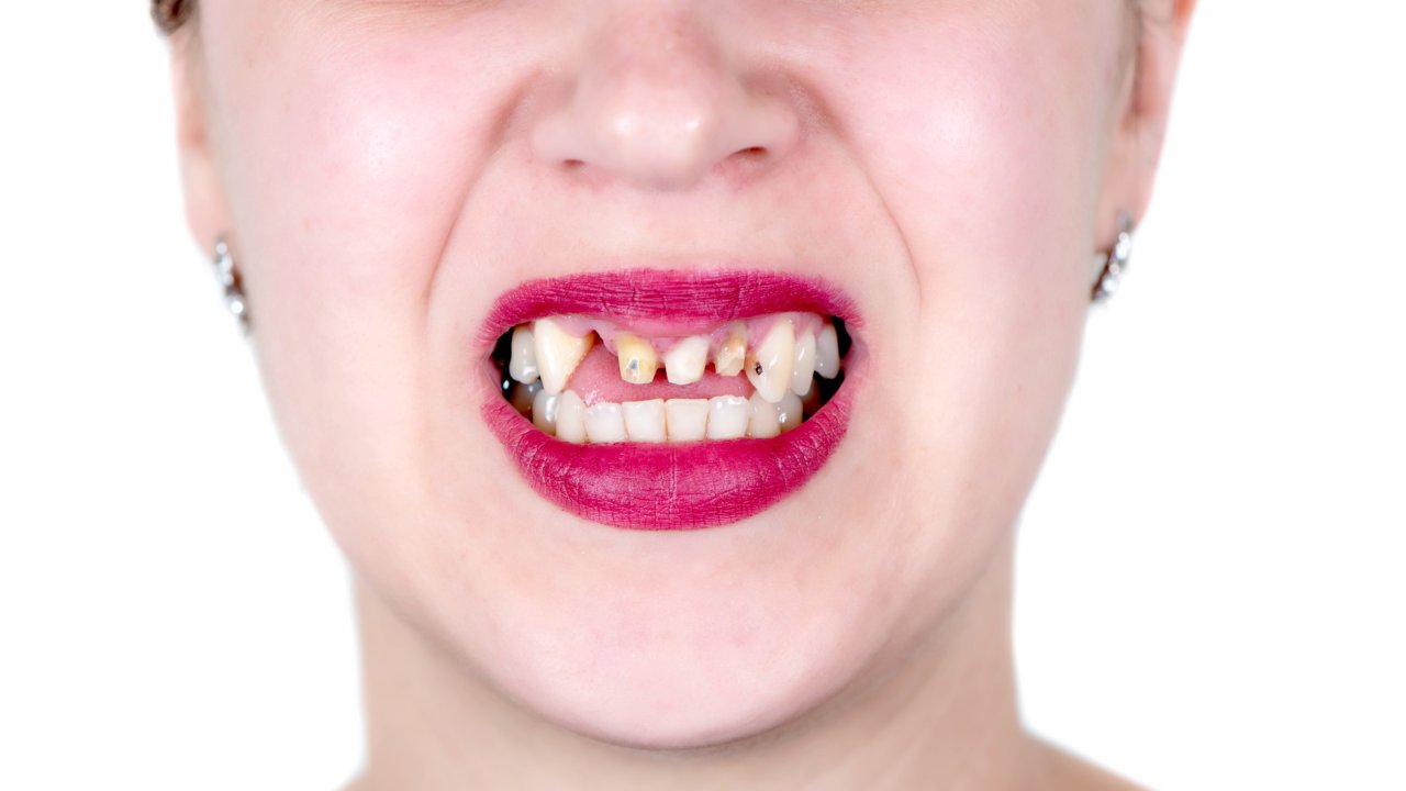 Denti mancanti (depositphotos) - zapster.it